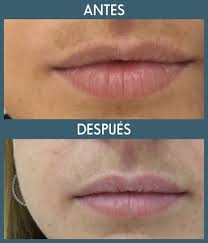 Conoce La Recuperacion Tras Un Relleno De Labios Acido Hialuronico