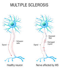 A title of respect prefixed to a woman's name or position: Multiple Sclerosis Wellness Guru Australia