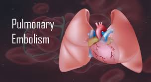Pulmonary Embolism The Killer Clot In The Lungs Myheart