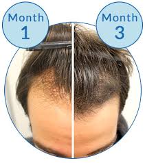 Products with minoxidil help many people regrow their hair or slow the rate of hair loss or both. Device May Predict Success Of Hair Loss Treatment Response