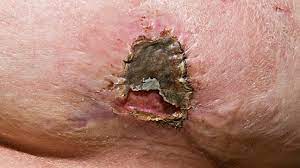 The affected area might be: Mrsa Staph Infection Pictures Symptoms Treatment And Prevention