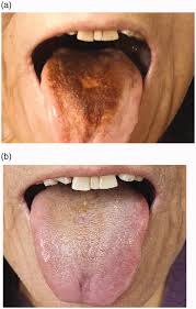 Image result for black tongue symptoms