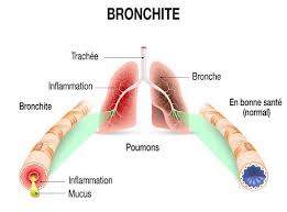Définie comme une toux persistant > 3 semaines. Toux Quand Faut Il Consulter Doctissimo