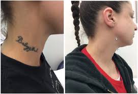 How much your tattoo removal will actually cost depends on a number of factors. Laser Tattoo Removal Cost In Greater Chicago Bareremoval