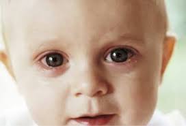 Goz Nezlesi Cesitli Mikroplarin Goze Bulasmasi Sonucunda Goz Kapaklarinin Ic Kisminda Meydana Gelen Yanma Ve Sismedir Eye Health Informati Gozler Tintin