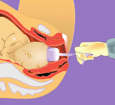 Image result for Vacuum Caput