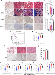 When sarcoidosis affects the lungs, symptoms can mimic idiopathic pulmonary fibrosis including shortness of breath and a dry cough. Lung Gene Expression Signatures Suggest Pathogenic Links And Molecular Markers For Pulmonary Tuberculosis Adenocarcinoma And Sarcoidosis Communications Biology