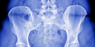 Are the strings longer or shorter than before? Iud Complications Ob Gyns Discuss Expulsion And Perforation Self