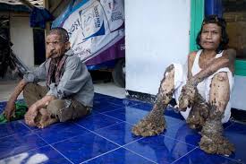 Epidermodysplasia verruciformis (ev), also known as treeman syndrome, is an extremely rare autosomal recessive hereditary skin disorder associated with a high risk of skin cancer. Can Females Get Tree Man Syndrome Bangladeshi Girl May Have Disease That Previously Affected Only Men
