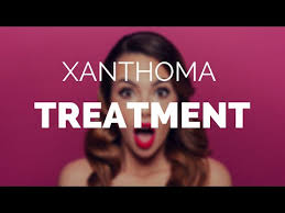 Formation of the nodules in the tendons of the hand, feet and heel is called xanthoma tendinosum eruptive xanthoma: Xanthoma Treatment How To Easily Remove Xanthoma Youtube
