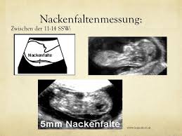 Für die nackenfaltenmessung gibt es nur ein recht enges zeitfenster zwischen der 11. Univ Doz Dr Heinz Leipold Ppt Video Online Herunterladen