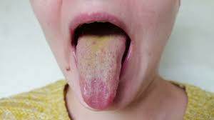 Image result for brown tongue symptoms