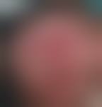 Image result for Pyoderma Gangrenosum