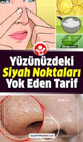 Yuzdeki Ve Ciltteki Siyah Noktalarin Beneklerin Bitkisel Yontemlerle Tedavisi Cilt Bakimi Siyah Noktalar Cilt Bakimi Cilt Tedavileri