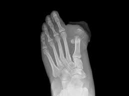Image result for toe amputation