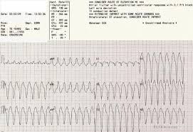 We are the home of ekg professionals, amateurs, and anyone else interested in interpreting ekgs. Ventricular Tachycardia Ecg Guru Instructor Resources