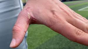 Ryan Wrobleski's fight to return to the diamond