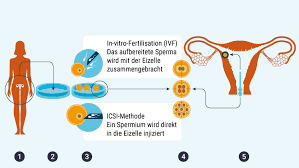 Kunstliche Befruchtung Focus Arztsuche