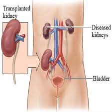 Procedures Of Kidney Transplant Surgery Kidney Transplant Renal Transplant Transplant