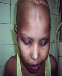 A 6-year-old child with unilateral proptosis, diagnosed with precursor...