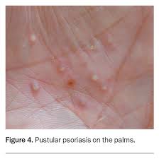 Image result for Pustular Psoriasis
