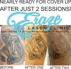 Yelp is a fun and easy way to find, recommend and talk about what's great and not so great in coolangatta and beyond. Pin On Laser Tattoo Removal Gold Coast