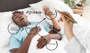 Image result for Sleep Apnea