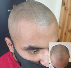 Quality that goes into scalp micropigmentation cost . Scalp Micropigmentation Glasgow Scalp Micro Scotland