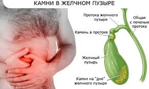 Kamen V Zhelchnom Puzyre Lechenie Bez Operacii Simptomy