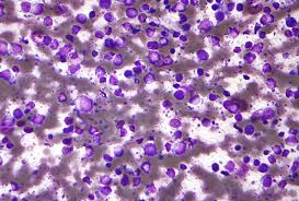 Lymphomas are the most common type of blood cancers. Diffuse Large B Cell Lymphoma Wikipedia