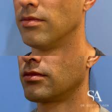 Scott allison is trained to handle a range of common skin issues, including everything from moles and rashes to acne treatment & wrinkle management. The Jawline Is A Dr Scott Allison Cosmetic Physician Facebook