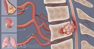 My doctor says i have bone cancer, but i don't understand. Metastatic Spine Tumors
