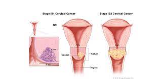 Maybe you would like to learn more about one of these? Kanker Serviks Adi Husada Cancer Center Ahcc