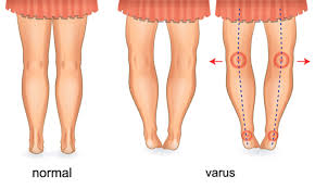 Sings and symptoms of clubfoot. 4 Possible Conditions Affecting Your Child S Movement Health Plus