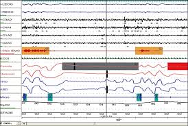 Image result for Polysomnogram