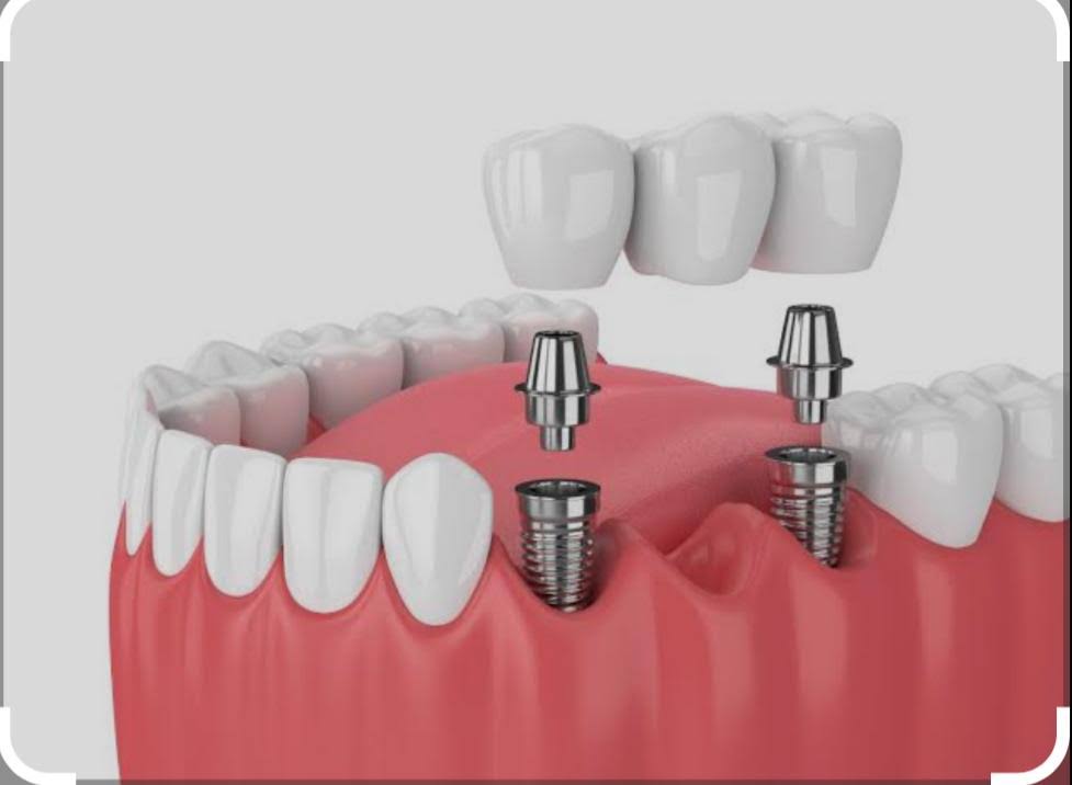 Dental Implants product image