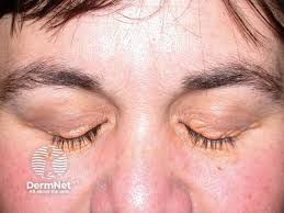 Image result for xanthelasma of eyelid