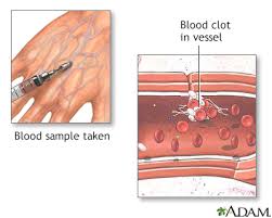 Image result for Protein C Deficiency
