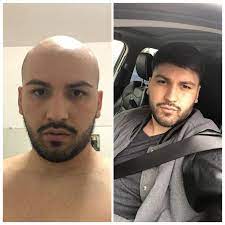 Hairweavon is a leading provider of men's hair replacement systems. Lavivid Non Surgical Hair System Pre Style Service Hair Replacement Systems Hair System Hair Replacement