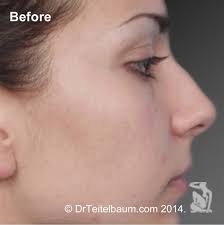 Rhinoplasty Before and After Photos by Steven Teitelbaum, MD; Santa Monica,  CA