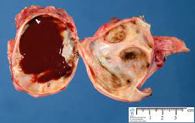 Endometriosis is a condition where tissue similar to the lining of the womb starts to grow in other places, such as the ovaries and fallopian tubes. Webpathology Com A Collection Of Surgical Pathology Images