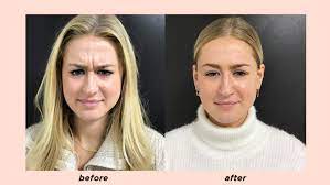 Abcam.com has been visited by 10k+ users in the past month Botox Before After Review A 22 Year Old S Honest Thoughts Stylecaster