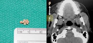 This allows the salivary gland ducts to be explored and small instruments can be inserted. Can I Avoid Surgery After A Failed Sialendoscopy