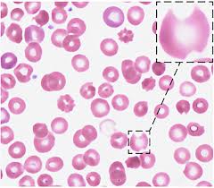 Image result for Peripheral Smear