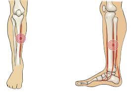 Image result for periostitis