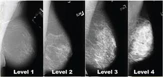 I have been in remission for the past 4 years. How Dense Are You Dennis R Holmes M D F A C S Breast Cancer Surgeon