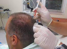Whether hair loss is caused by aging, disease, genetics, stress, or hormonal imbalance millions of people are searching for a solution. The Prp Vampire Hair Regrowth Plan