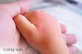 Image result for sweat rash on back baby