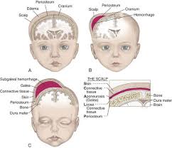 Image result for Cephalhematoma