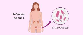 Infecciones urinarias: causas, síntomas y tratamientos